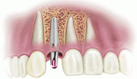 Implante ya cicatrizado y adherido al hueso periodontal. Es una de las mejores alternativas a la hora de recuperar el diente en su función y estética,
